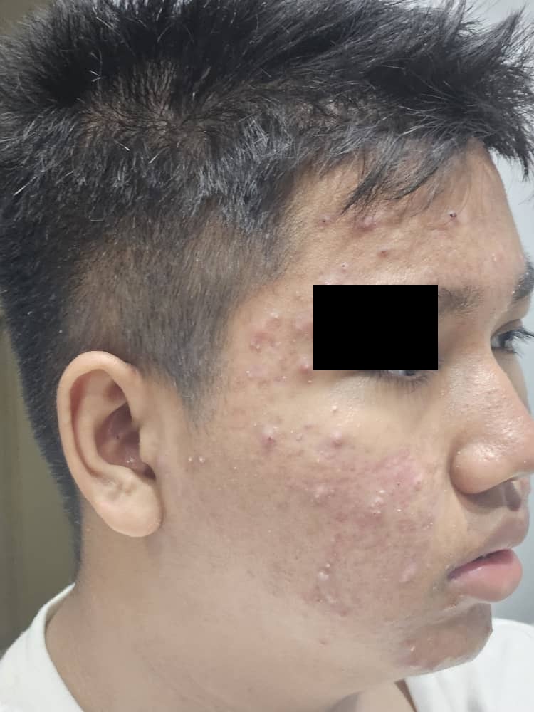 Facial acne before treatment